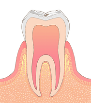 C0【ごく初期の虫歯】