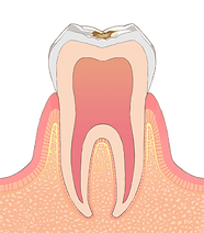 C1【エナメル質の虫歯】