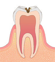 C2【象牙質の虫歯】