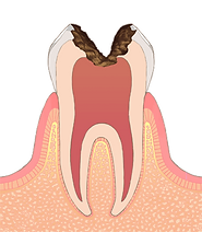 C3【神経の虫歯】