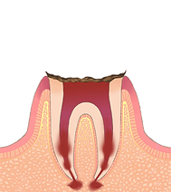 C4【歯根の虫歯】