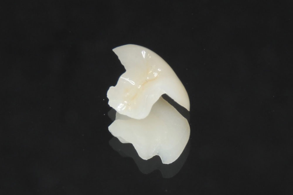 オールセラミック