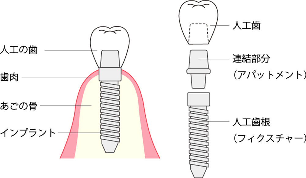 インプラントの構造