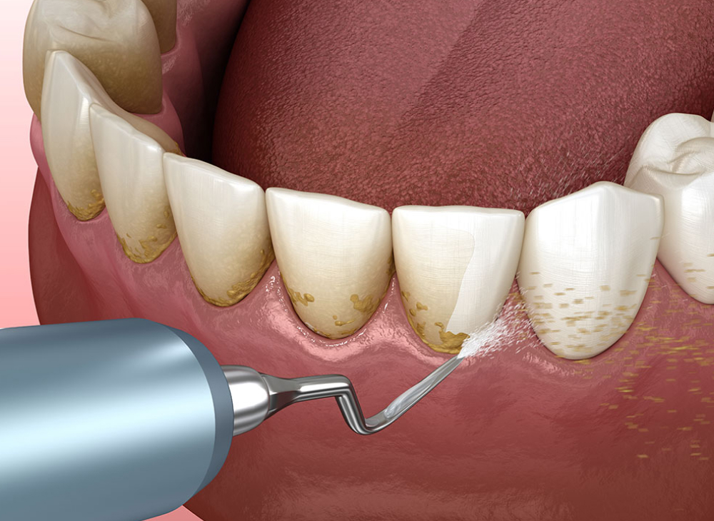 歯のクリーニング